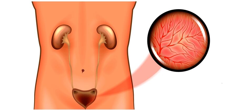 Cystitis a férfiak tüneteiben és kezelésében