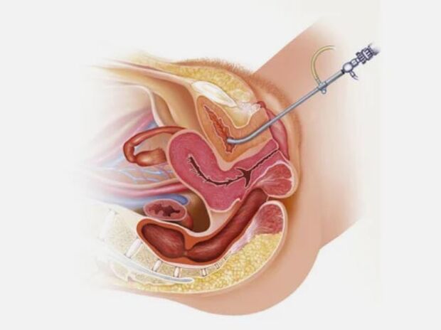Cystitis diagnosztizálása